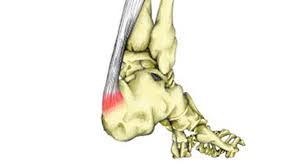 It is a tendon that joins your calf muscles to the heel bone. Insertional Achilles Tendonitis Symptoms Causes Treatment Rehab