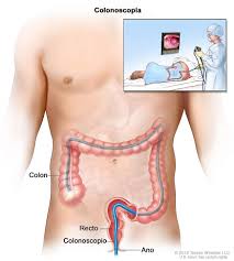 The most common types of cancer i know of are skin cancer, lung cancer, and liver cancer, bowel cancer. Nih Study Finds Sigmoidoscopy Reduces Colorectal Cancer Rates National Institutes Of Health Nih