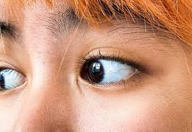 Image result for melanosis sclera