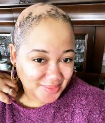 Mesotherapy for hair loss before & after results | platelet rich plasma for hair loss. Life Update I Have Androgenetic Alopecia Whitney Nic James Androgenetic Alopecia Relaxed Hair Growth Alopecia Hairstyles