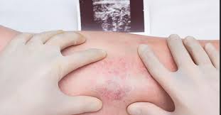 A change in the shape or inner surface of a vessel wall may impede blood flow. 13 De Octubre Dia Mundial De La Trombosis Enfoque Noticias