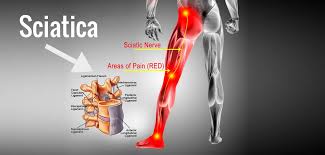 If these are left untreated, permanent nerve damage can occur, leading to muscle weakness or loss of sensation. Sciatica Kaizo Health Chiropractic Rehab Maryland Virginia D C
