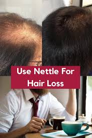 Dried nettle or nettle extracts are said to help combat dandruff, scabs, hair loss, and baldness. How To Use Nettle For Hair Loss Tea Or Tincture Hair Loss Women Hair Loss Women Treatment Help Hair Loss