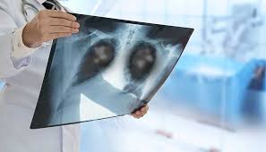 These are new from the radiograph of 5 years previously, but have been seen on cross sectional imaging. What Are The Symptoms Of Metastatic Lung Cancer Moffitt