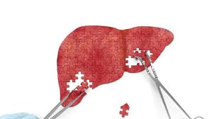 Penyakit hepatitis adalah peradangan hati. Ciri Ciri Kamu Kena Hepatitis A Mata Kuning Salah Satunya