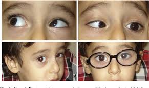 Surgical treatment of Duane retraction syndrome