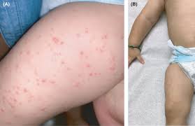 Image result for Papular Acrodermatitis