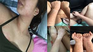 Ngeri Dianggap Remeh Bintik Merah Gadis Ini Berubah Ruam Di Sekujur Tubuh Penyebabnya Tribun Manado
