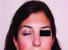 Four months after the surgical treatment.