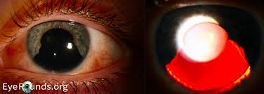 Image result for Hyphema