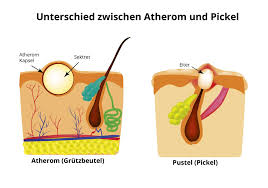 Wie Unterscheidet Sich Ein Atherom Von Einem Pickel