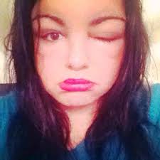 If you have black hair or dark hair but wish to go lighter, and the thought of chemical hair dyes make you cringe or worse you had a bad reaction you do not have as many choices. Hair Dye Almost Killed Me Twice The Sun