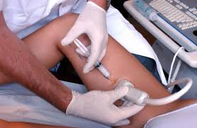 reticular vein sclerotherapy improved with polidocanol plus