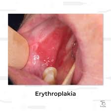 Image result for Erythroplakia roof of mouth