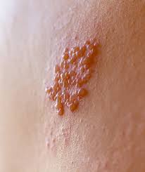 Image result for shingles
