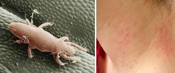 Image result for mite bites on humans