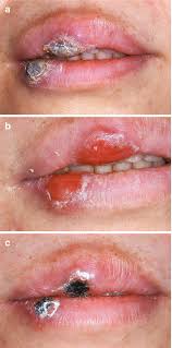 Image result for Primary Syphilis