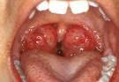 Tonsilitis Diagnosis - Diseases and Conditions - PDR Health
