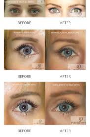 This microblading course is ideal for students with no previous experience of microblading and are entering the industry for the first time. Miami Beach Plastic Surgery Leonard Tachmes M D P A Forehead Lift Miami Brow Lift Miami Dr Tachmes Md