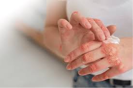 Image result for Leprosy