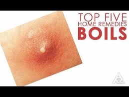Homeremediesforboils Homeremedyforboils Boilremedies Boilsymptoms Boilsinkids Treatboilinkids Home Remedy For Boils Natural Remedies For Boils Remedies
