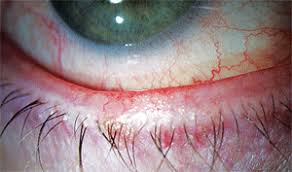 As you get older, the blepharitis wiki recommends buying ocusoft eyelid cleanser which leaves the skin very hydrated. Blepharitis And Dry Eye A Common Yet Complicated Combination