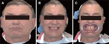 Integrating 3D facial scanning in a digital workflow to CAD/CAM design and  fabricate complete dentures for immediate total mouth rehabilitation.