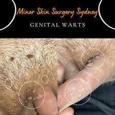 Image result for genital warts
