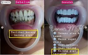 Karang gigi atau sering sering disebut kalkulus gigi merupakan plak yang mengeras pada gigi. Kortugi Garis Receh On Twitter Solusi Menghilangkan Karang Gigi Level Sultan Adalah Dengan Menutupnya Dengan Veneer Via Veneergigiputih29 Ig