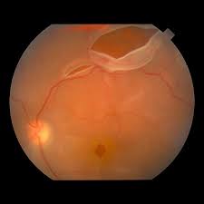 Image result for Retinal Detachment