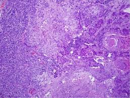 About 85% of cases are related to. Update On Small Cell Carcinoma And Its Differentiation From Squamous Cell Carcinoma And Other Non Small Cell Carcinomas Modern Pathology