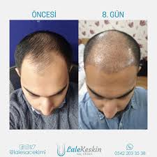 Lale Keskin Sac Ekimi Sur Twitter Ingiltere Den Gelen Hastamiz Fue Sac Ekiminin Ardindan Yalnizca 7 Gun Sonra Dogal Sac Gorunumune Kavustu Lalekeskin Sacekim 90 542 203 35 38 90
