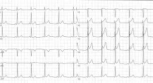 Viren und bakterien, die den infekt auslösen, können unbehandelt zum herzmuskel vordringen und eine. J Punkt Und J Welle Fokus Ekg