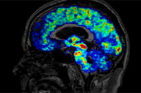 According to healthresearchfunding.org, concussion rates for children under age 19 who play tackle football have doubled over the last decade, most occurring during practices. Johns Hopkins Study Of Retired Nfl Players Sheds Light On Concussion Related Brain Damage Hub