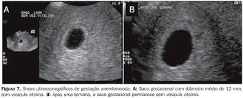 Radiologia Brasileira Anormalidades Do Primeiro Trimestre Da Gravidez Ensaio Iconografico