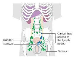 Whether you or someone y. Prostate Cancer Treatment Cost In India Best Prostate Cancer Surgery In India