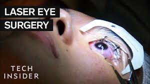 What It S Like To Get Laser Eye Surgery Eye Surgery Laser Eye Surgery Laser Eye