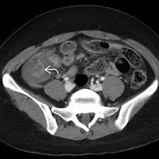 Image result for Neutropenic Colitis