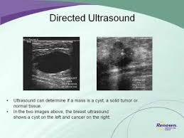 Breast ultrasound is not usually done to screen for breast cancer. Early Symptoms Of Inflammatory Breast Cancer