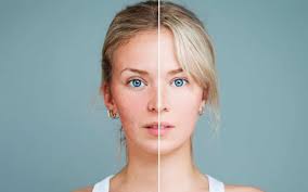 Laser Genesis® Skin Therapy