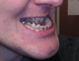 Tooth extraction to relieve the pressure of overcrowding and help the jaw relax into a more natural position. Common Problems Underbite Orthodontics In London