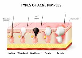 Many patients do well with over the counter benzoyl peroxide or salicylic acid preparations. What Are Blackheads Biore Skincare Blog