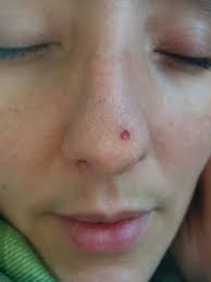 Image result for skin cancer on nose pimple