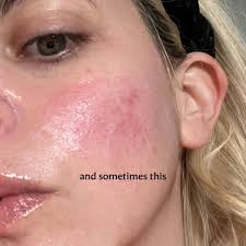 A realistic day to day living with Rosacea x there is no cure, but there  are Estheticians that can help manage ;) x x x x #skinhealth #skin #rosacea  #rosaceatreatment #esthetician #skincare #