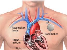 Pacemakers and implantable cardioverter defibrillators (icds) are small devices that deliver energy to the heart through thin, flexible wires called leads. Iphone 12 May Pose A Great Danger To Heart Patients Iphone Islam