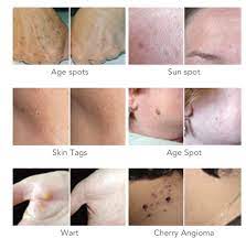 Cryotherapy Spray Skin Tag Removal N2o Liquid Nitrogen Mole Removal Cryo Pen Ebay