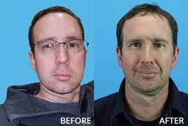 Typically, the doctor makes one long incision in your hip to remove the bone and. Before And After Facial Plastic Surgery Washington University