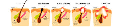 Check spelling or type a new query. Remedii Anti Acnee Remedii Naturiste Creme Anti Acnee