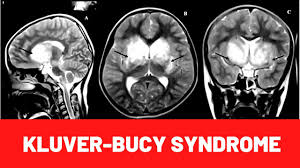 Kluver Bucy Syndrome Symptoms Causes Treatment Youtube