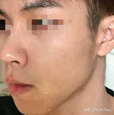 长期用a 醇真的对皮肤好吗？